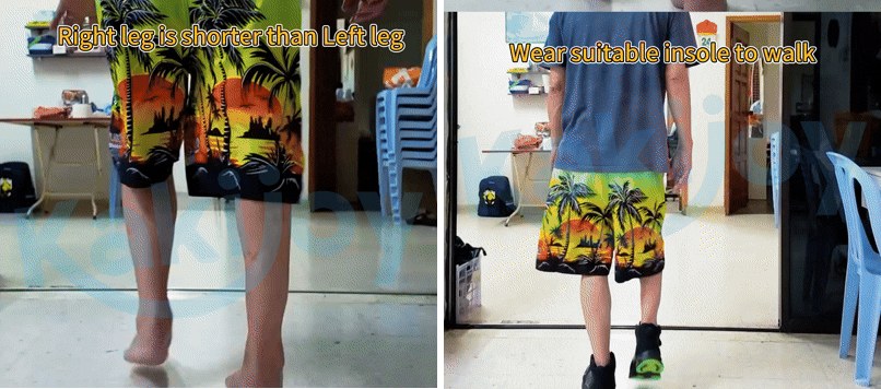 Before and after comparison of a man's leg length difference, barefoot versus wearing a corrective insole